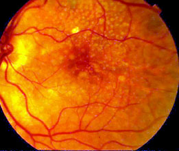 Macular Degeneration Manhattan