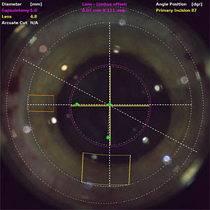 Laser Cataract Surgery Manhattan