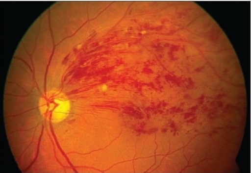 Branch Retinal Vein